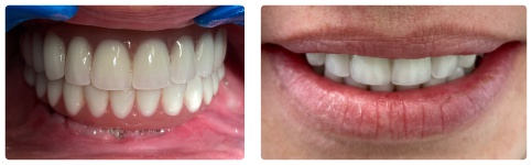 Zęby w Jeden Dzień - efekt po leczeniu