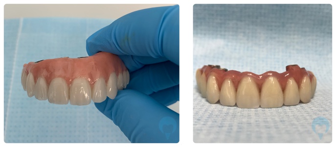 Zęby w Jeden Dzień - most stały na implantach
