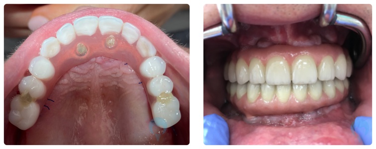 Nowe Zęby w Jeden Dzień - osadzone mosty na 4 implantach