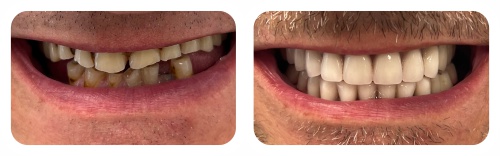 Nowe Zęby w Jeden Dzień przykład po zabiegu.