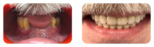 Nowe Zęby w Jeden Dzień przykład po zabiegu.